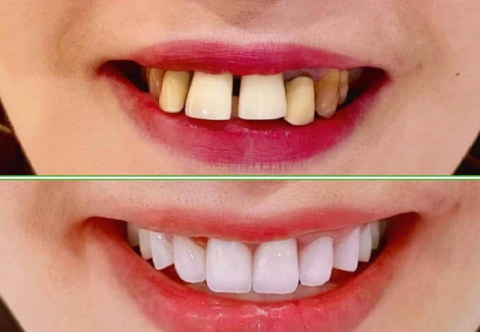 9 trường hợp không nên bọc răng sứ bạn nên biêt